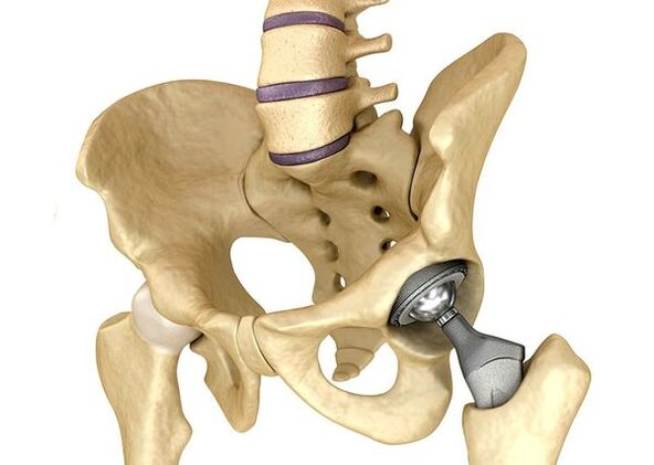 Lipotherapy of the hip joint