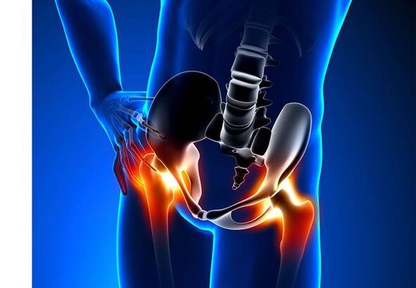 Pain for cokesarrosis