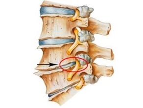 Signs and symptoms of osteochondicity