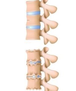 The causes of osteochondicity