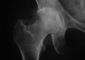 X-ray of the hip joint with arthropathy