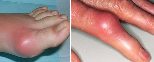 appearance of arthritic joints