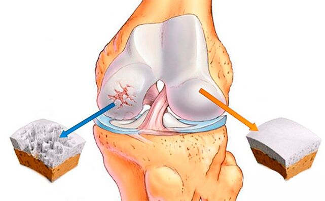 A normal knee joint (right) and one affected by arthropathy (left)