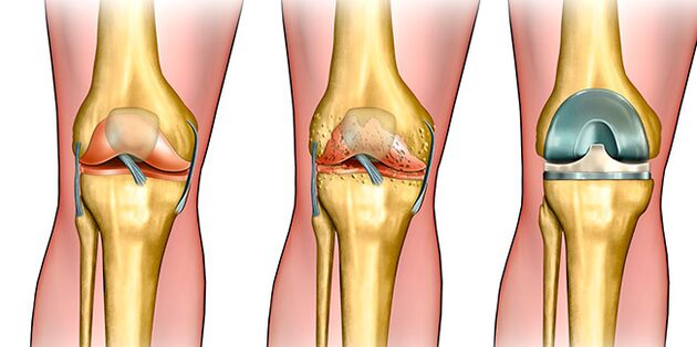 In the third stage of the joint, knee replacement is required