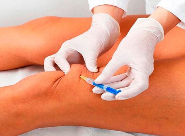 Intra-articular injections of medicines for joints of the knee joint