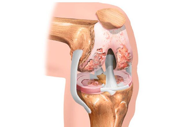 Knee joint summation
