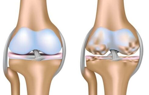 healthy joint and destruction of the knee joint in arthropathy