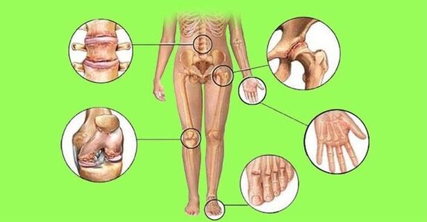 joints affected by arthritis and gout