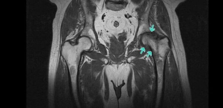 Degenerative-dystrophic changes in the hip joint on magnetic resonance imaging