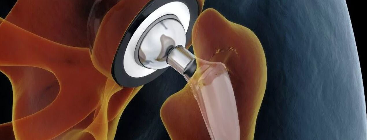 Endoprosthetic hip joint in last grade coxarthrosis