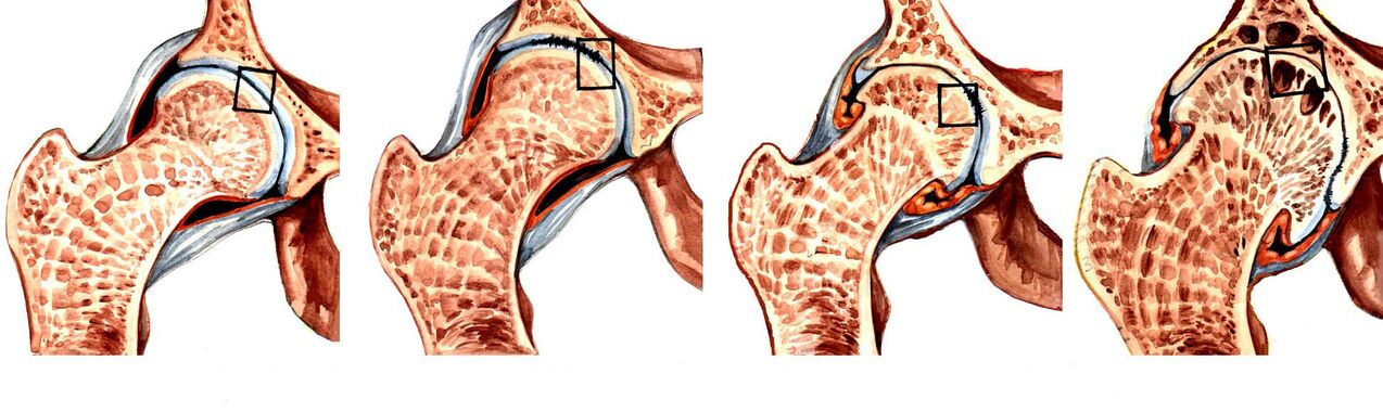 Grades of deforming coxarthrosis