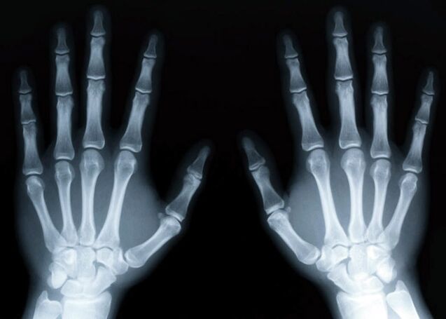 Gout causes gout to develop, which can be diagnosed with x-rays