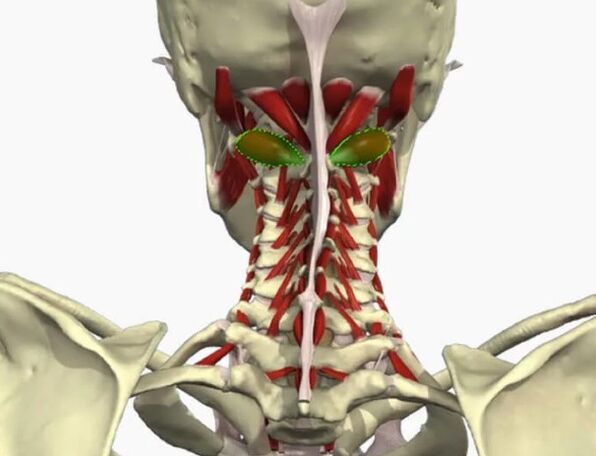 Artery syndrome