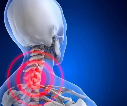 Cervical osteochondria